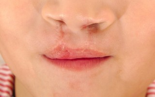 唇炎怎么治疗最有效（治疗唇炎，有效的措施有哪些，要注意什么？）